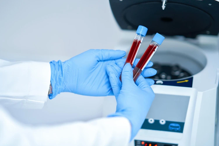 Test tubes of patient's blood to be sent for blood testing.