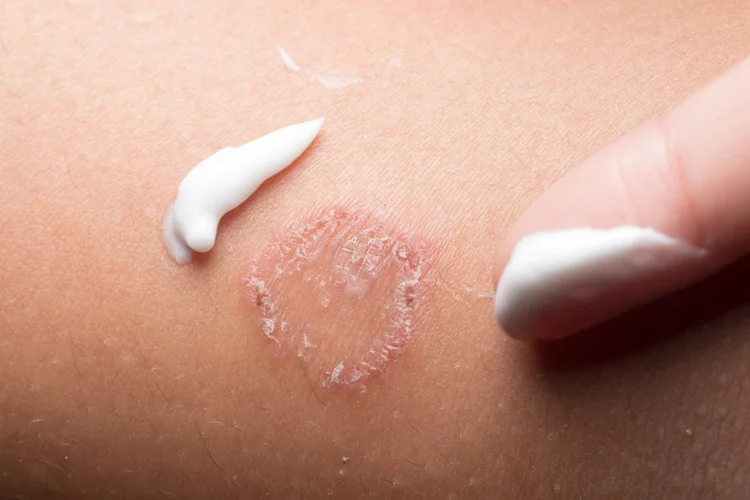 Circular scaly rash with central clearing, possibly ringworm or tinea fungal infection.