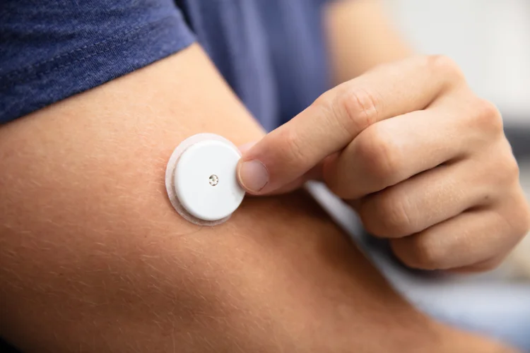 Close-up of continuous glucose monitoring (CGM) sensor applied to upper arm for diabetes management.