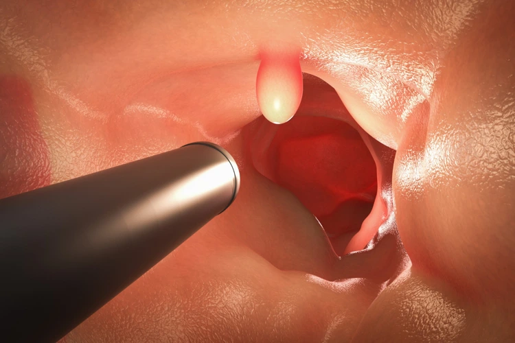 3D image of colonoscopy with endoscope inside of intestine with polyp.