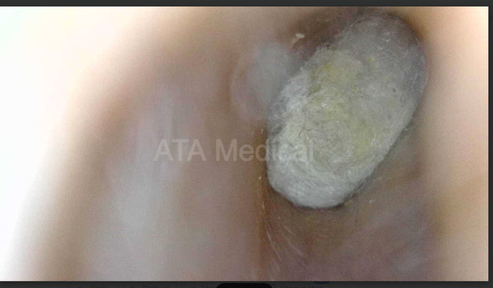 Cotton fibres trapped within impacted ear wax extracted during a professional ear wax removal procedure at ATA Medical.