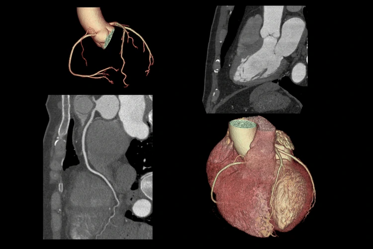 3D Scan CTA Coronary artery, coronary tree with long axis view and vessel trace.