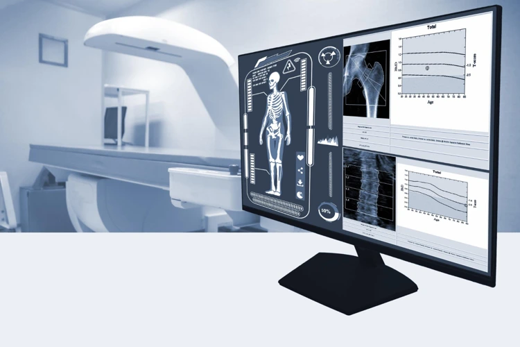 A DEXA scan machine and computer monitor displaying patient's Bone Mineral Density (BMD) data.