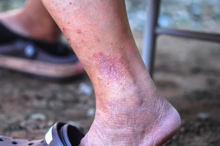 Dry scaly leg patches with flaking skin, possibly eczema or a superficial fungal infection.