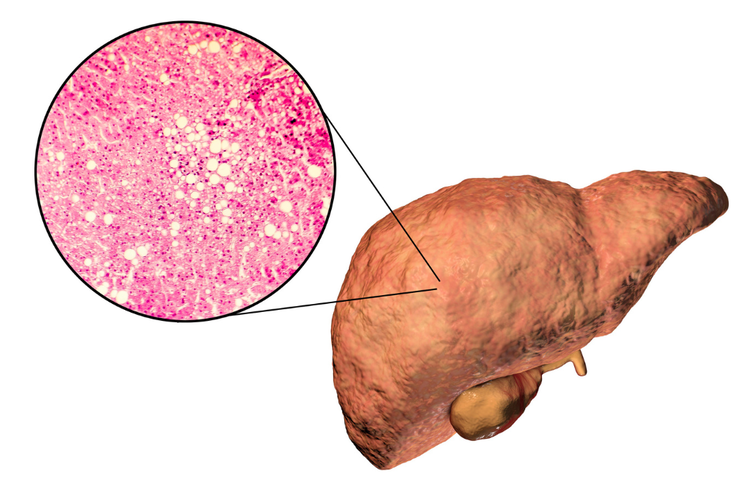 Medical illustration showing liver with fat accumulation and microscopic fat deposits.