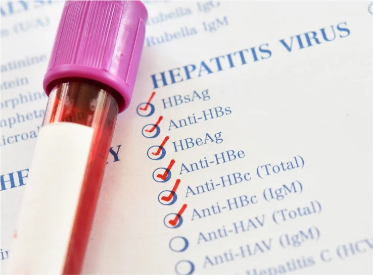 Hepatitis B test result and sample vial showing diagnostic markers for chronic infection.