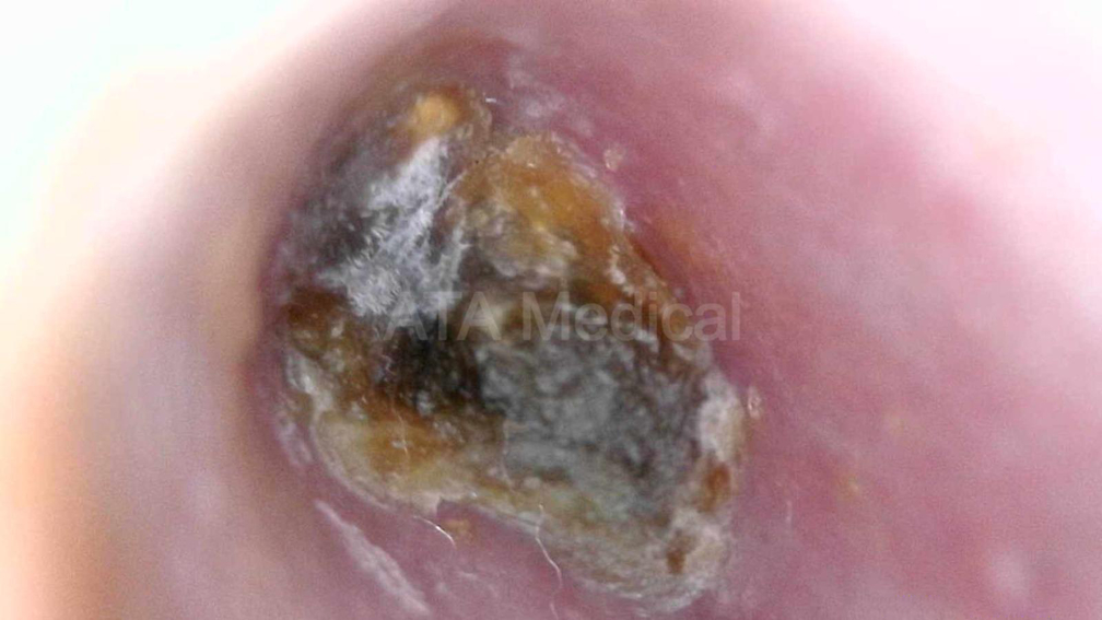 Endoscope view of severely impacted ear wax lodged against the eardrum inside the ear canal.