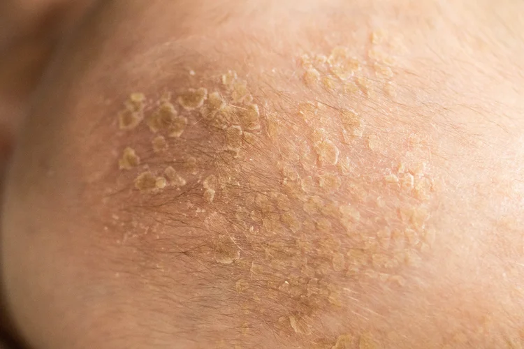 Rash with yellowish crust and scaling, possibly weeping eczema or a skin infection.