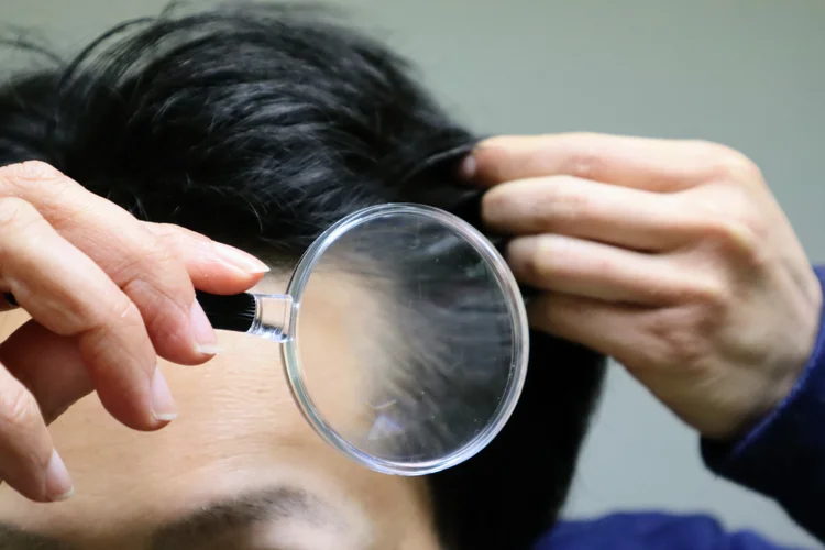 Man using magnifying glass to check for hair thinning or receding hairline.