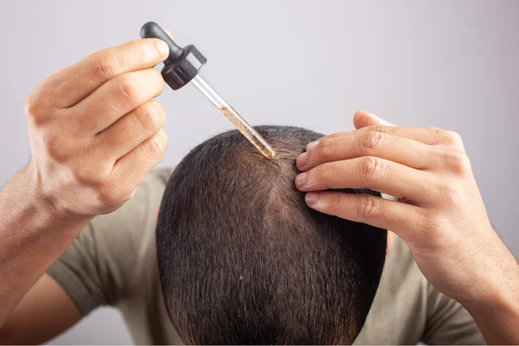 Man applying topical hair loss treatment with dropper to combat thinning scalp.