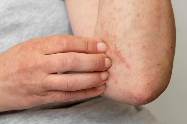 Person with skin allergic reaction on the arm due to Measles.