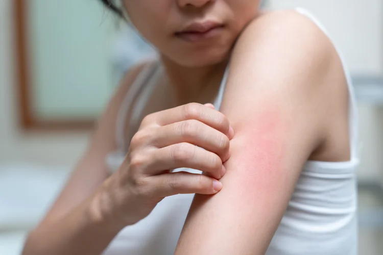Red itchy rash with inflammation on arm, possibly from irritation or an allergic skin reaction.