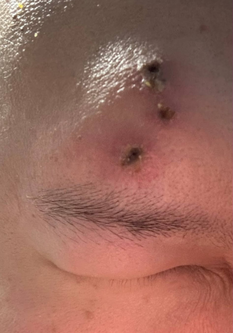 Shingles rash with blisters on a person's forehead.