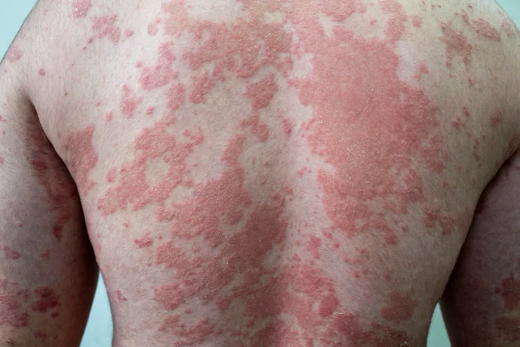 Thickened, inflamed skin with raised patches from chronic irritation or repeated scratching.